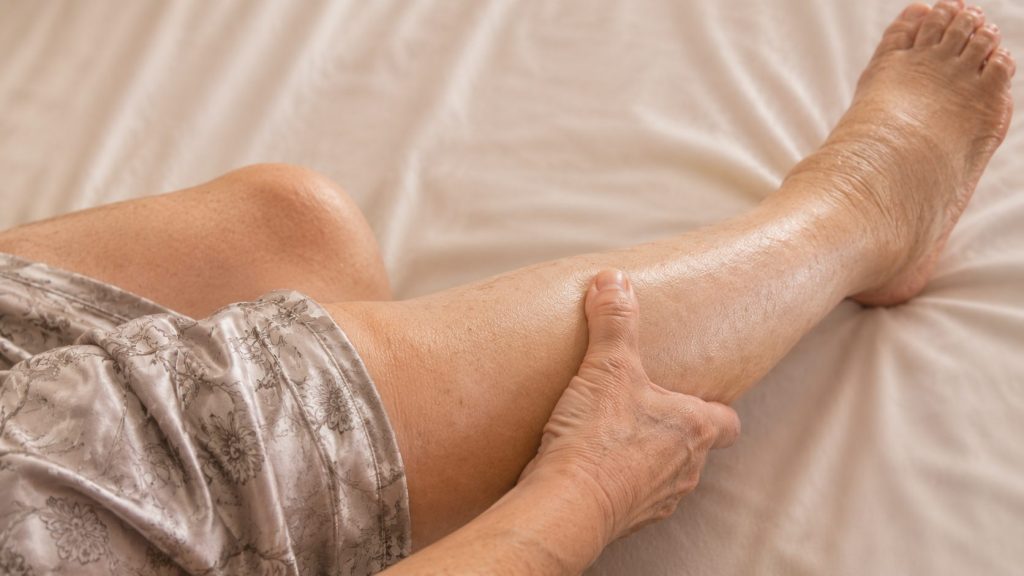 Swollen legs edema lymphoedema